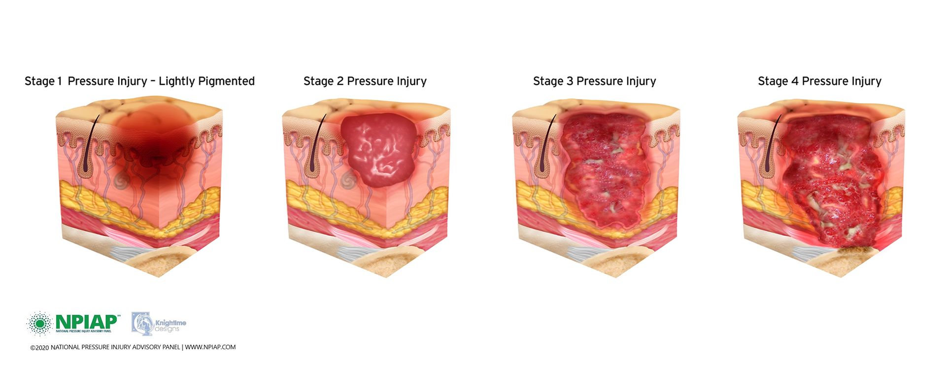 Pressure ulcer development stages